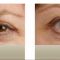 Botulinum toxin - Wrinkle Removal