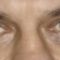 Eyelid surgery (Blepharoplasty)