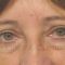 Eyelid surgery (Blepharoplasty)